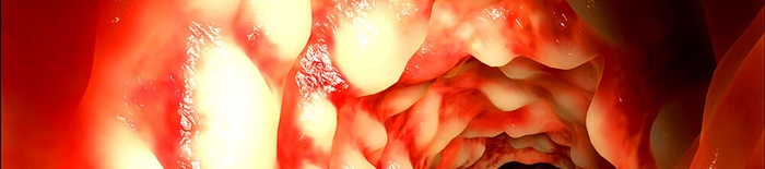 Colitis-ulcerosa1.jpg