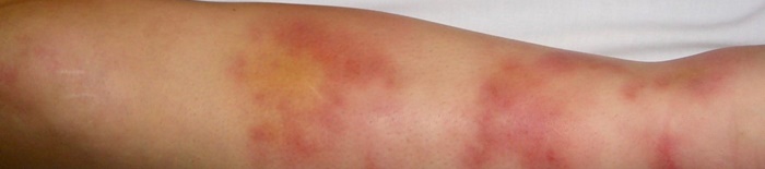 AllergischeKontaktdermatitis1.png