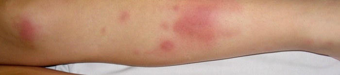AllergischeKontaktdermatitis1.png