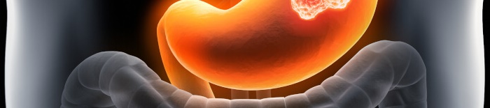 Colitis-ulcerosa1.jpg