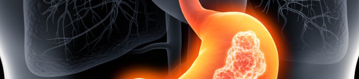 Colitis-ulcerosa1.jpg