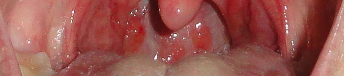 PneumonieKrankheitenandernorts1.jpg