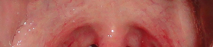PneumonieKrankheitenandernorts1.jpg