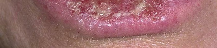 desmesothelialenGewebes1.jpg