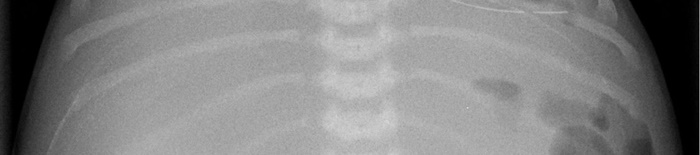 HydropsfetalisdurchhamolytischeKrankheit169c89eaccf1e99ff.jpg