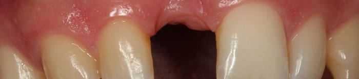 Colitis-ulcerosa1.jpg