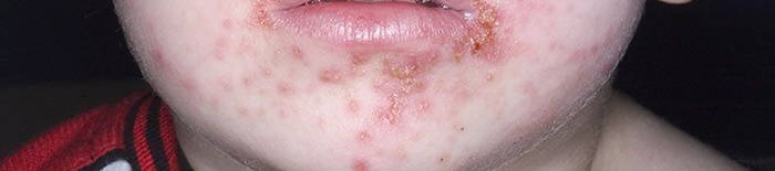 AllergischeKontaktdermatitis1.png