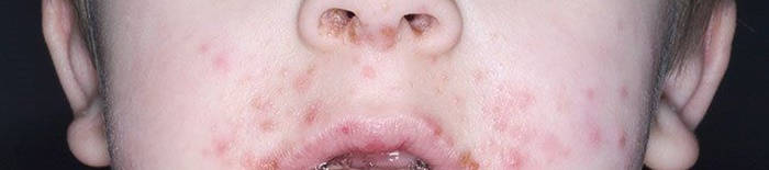 AllergischeKontaktdermatitis1.png