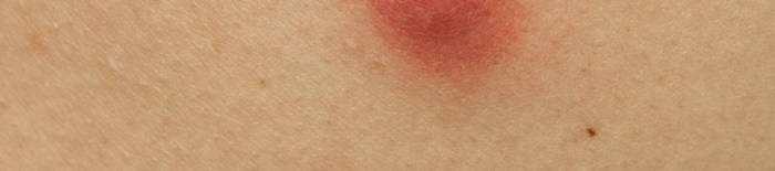 AllergischeKontaktdermatitis1.png