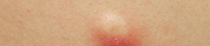 AllergischeKontaktdermatitis1.png
