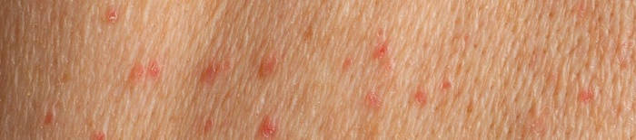 AllergischeKontaktdermatitis1.png