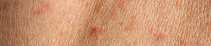 AllergischeKontaktdermatitis1.png