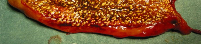 HydropsfetalisdurchhamolytischeKrankheit169c89eaccf1e99ff.jpg