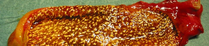 HydropsfetalisdurchhamolytischeKrankheit169c89eaccf1e99ff.jpg