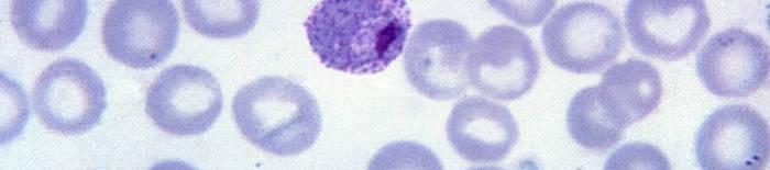 Dermatophytose1.jpg