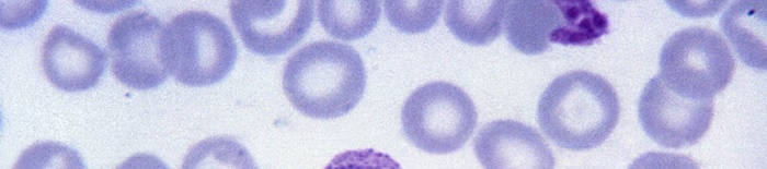 Dermatophytose1.jpg