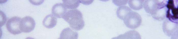 Dermatophytose1.jpg