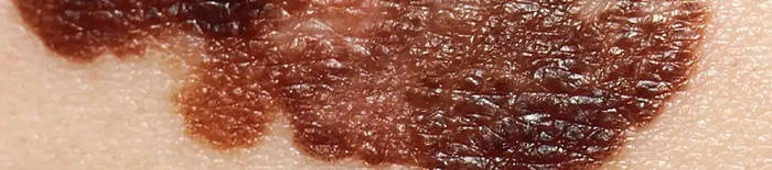 desmesothelialenGewebes1.jpg