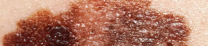 desmesothelialenGewebes1.jpg