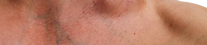 desmesothelialenGewebes1.jpg