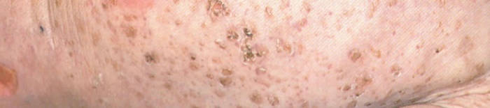 desmesothelialenGewebes1.jpg