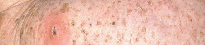 desmesothelialenGewebes1.jpg