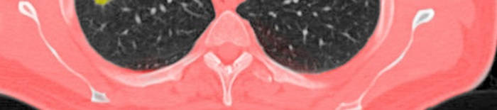 desmesothelialenGewebes1.jpg