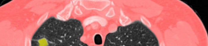 desmesothelialenGewebes1.jpg