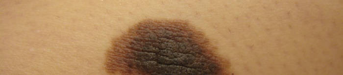 desmesothelialenGewebes1.jpg