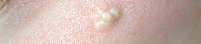 desmesothelialenGewebes1.jpg