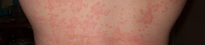 desmesothelialenGewebes1.jpg