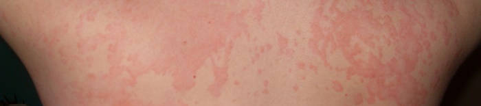 desmesothelialenGewebes1.jpg
