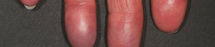 desmesothelialenGewebes1.jpg
