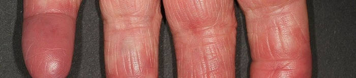 desmesothelialenGewebes1.jpg