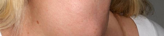 Colitis-ulcerosa1.jpg