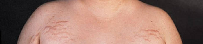 Colitis-ulcerosa1.jpg