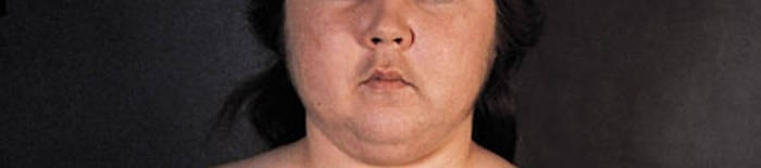 Colitis-ulcerosa1.jpg