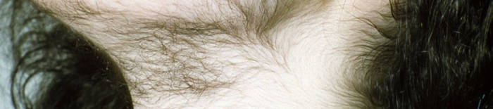 Colitis-ulcerosa1.jpg