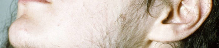 Colitis-ulcerosa1.jpg