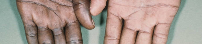 Colitis-ulcerosa1.jpg