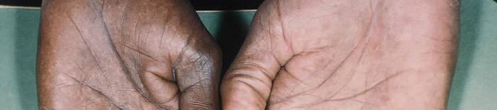 Colitis-ulcerosa1.jpg