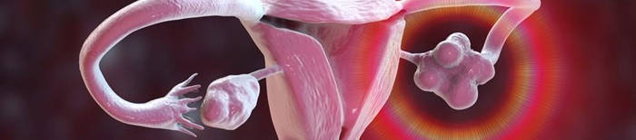Colitis-ulcerosa1.jpg