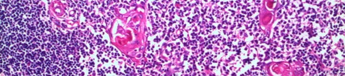 Colitis-ulcerosa1.jpg