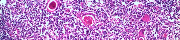 Colitis-ulcerosa1.jpg