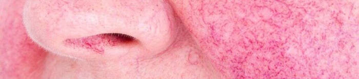 Colitis-ulcerosa1.jpg