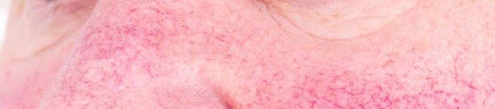 Colitis-ulcerosa1.jpg