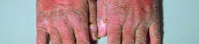 Colitis-ulcerosa1.jpg