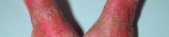 Colitis-ulcerosa1.jpg