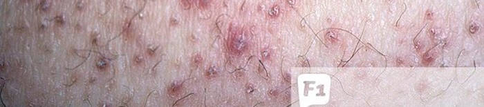 Colitis-ulcerosa1.jpg
