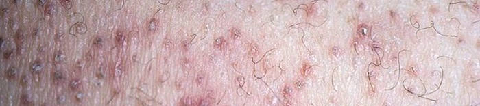Colitis-ulcerosa1.jpg